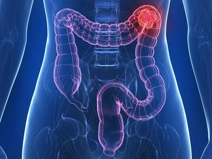 Cancer-Colon